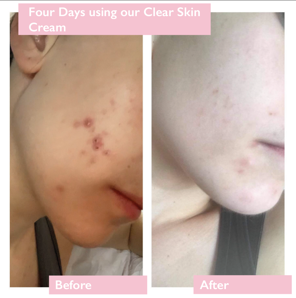 Acne Before and After Using Purity Clear Skin Cream